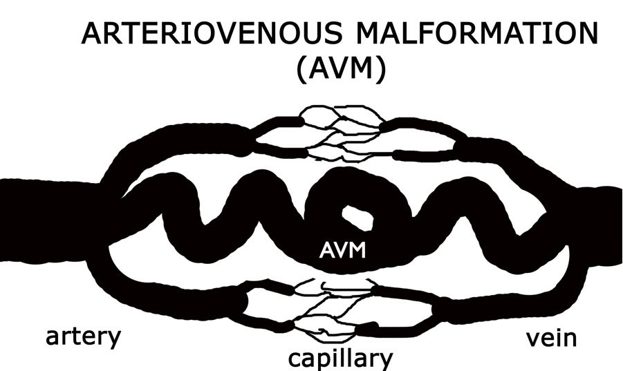 ARTERIOVENOUS MALFORMATION (AVM): DỊ DẠNG ĐỘNG TĨNH MẠCH