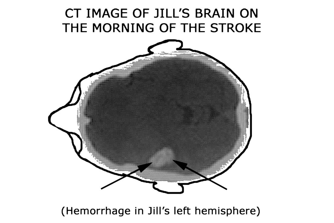 CT IMAGE OF JILL'S BRAIN ON THE MORNING OF THE STROKE: Hình ảnh CT não của Jill vào buổi sáng bị đột quỵ